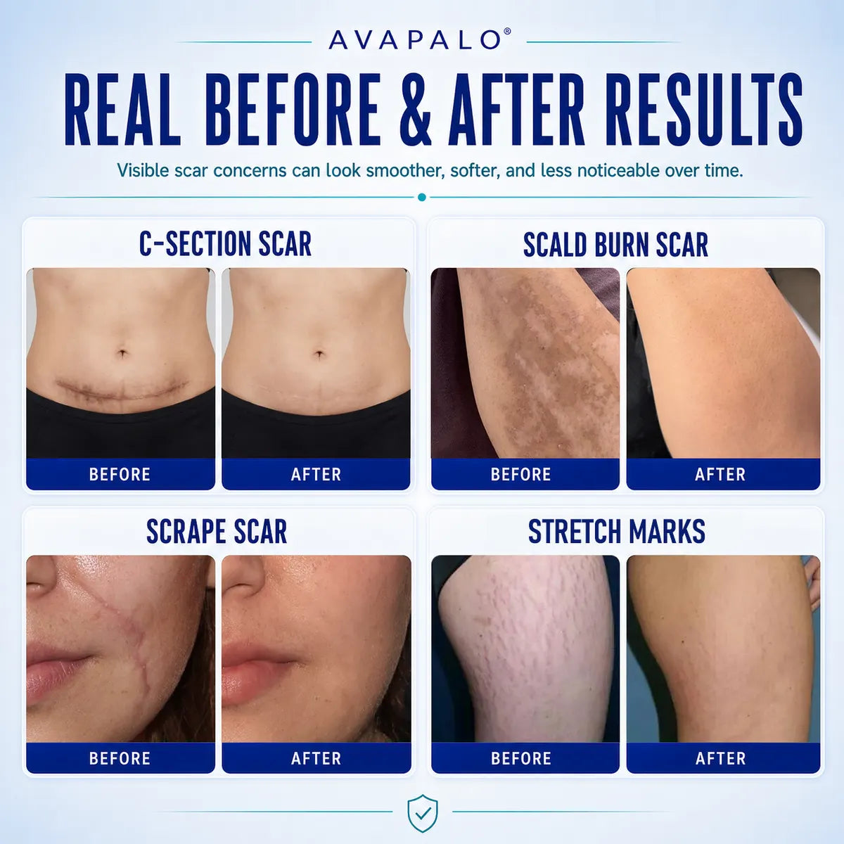 🌸Avapalo® Advanced Silicone Scar Gel – Professional Scar Removal Cream for Surgical Scars, Keloids, Stretch Marks, C-Section & Old or New Scars Repair Treatment (Copy)
