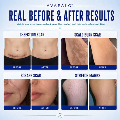 🌸Avapalo® Advanced Silicone Scar Gel – Professional Scar Removal Cream for Surgical Scars, Keloids, Stretch Marks, C-Section & Old or New Scars Repair Treatment (Copy)