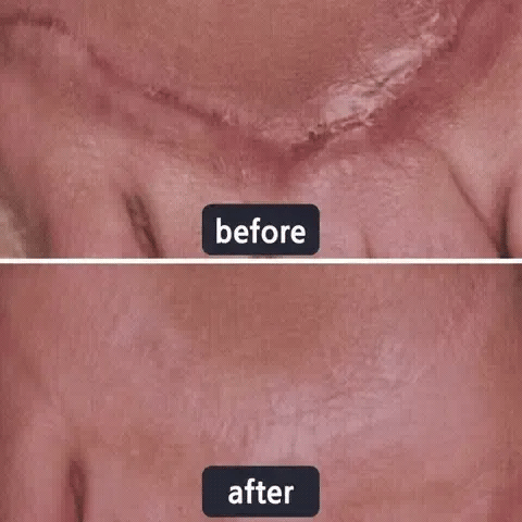 🌸Avapalo® Advanced Silicone Scar Gel – Professional Scar Repair Gel for Surgical Scars, Keloids, Stretch Marks, C-Section & Old or New Scars Treatment
