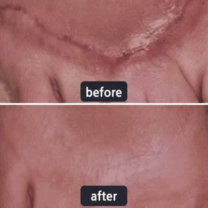 🌸Avapalo® Advanced Silicone Scar Gel – Professional Scar Repair Gel for Surgical Scars, Keloids, Stretch Marks, C-Section & Old or New Scars Treatment