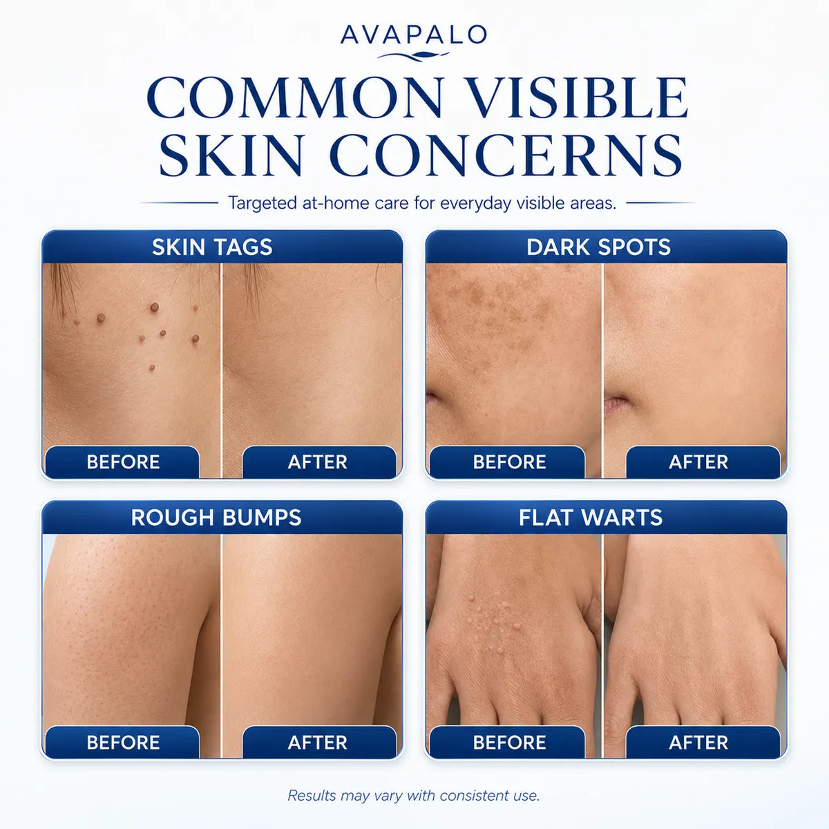 𝟕-𝐃𝒂𝘆 𝐒𝗸𝐢𝐧 𝐓𝒂𝗴 & 𝐒𝐩𝙤𝐭 𝐄𝐫𝒂𝐬𝙚𝐫 Painless & Scar-Free Advanced Imperfection Removal Rollerball Pen