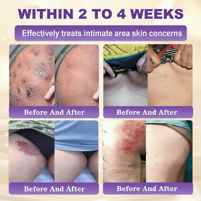 Avapalo® Advanced Silicone Scar Gel – Professional Scar Removal Cream for Surgical Scars, Keloids, Stretch Marks, C-Section & Old or New Scars Repair Treatment