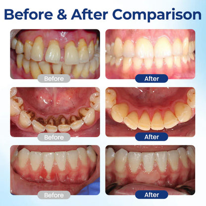 Avapalo® Oral Care Liquid– Effectively treats enamel damage, gum inflammation, toothaches, sensitive teeth, gum bleeding, periodontitis, cavities, mouth ulcers, and bad breath.